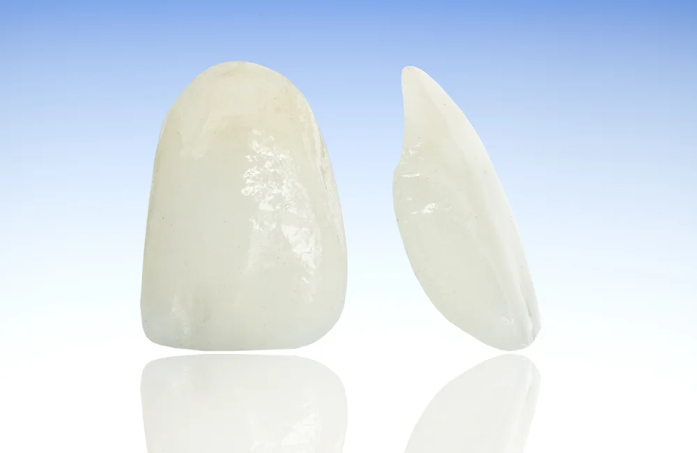 Mikroprotezavimas dantu laminatemis 1