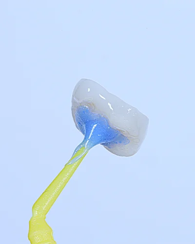 Mikroprotezavimas dantu laminatemis 3